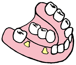 Bro på implantater hvis man mangler flere tænder