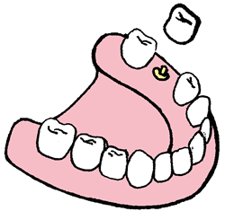 Implantat hvis man mangler en tand